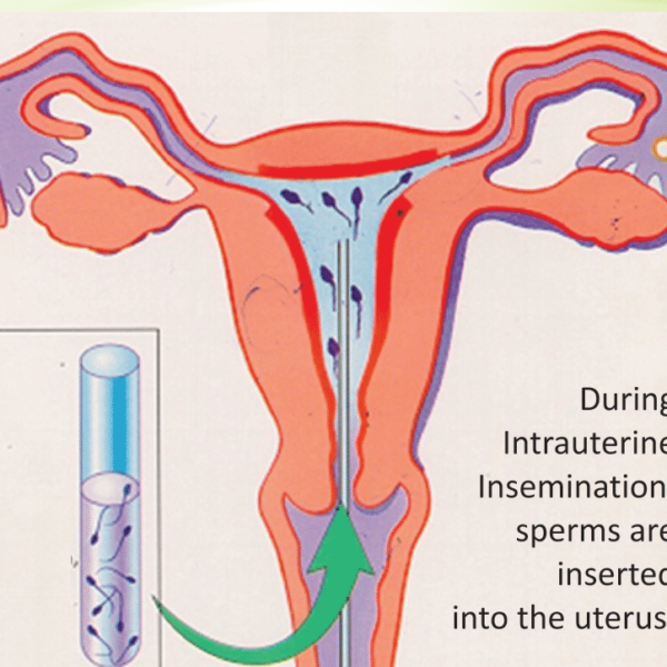 Intrauterine Insemination