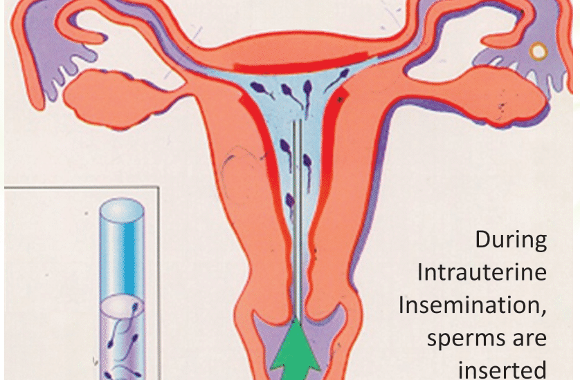 Intrauterine Insemination