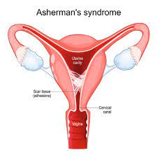 Asherman's Syndrome