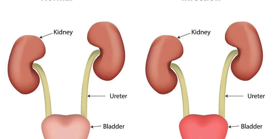 Urinary Tract Infection