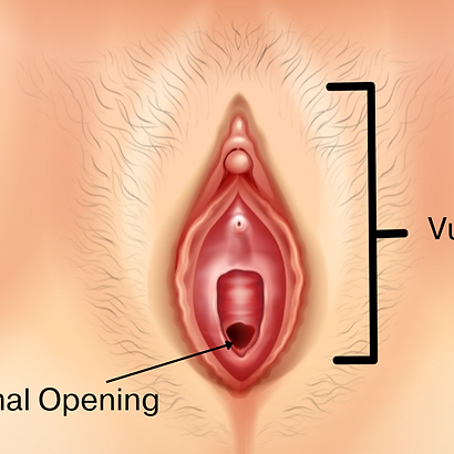 Vaginismus
