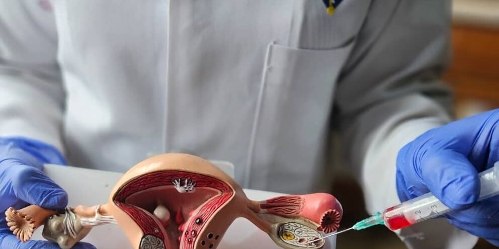 Ovarian reejuvanation-3 PRP for Ovarian Rejuvenation.