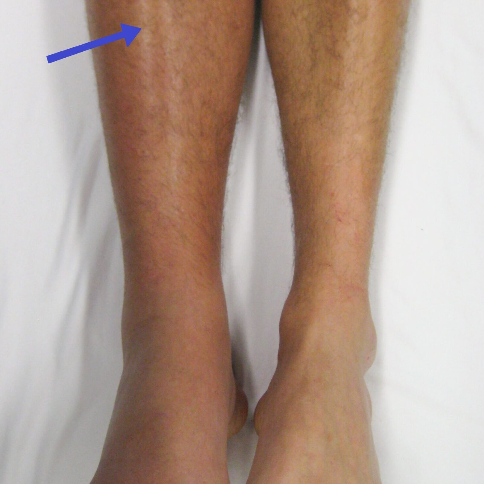 Management of Blood Clots.