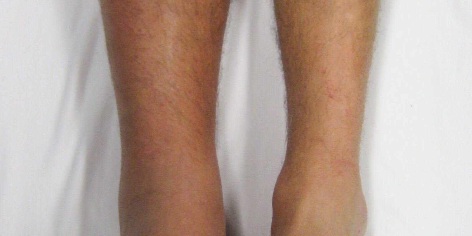 Management of Blood Clots.