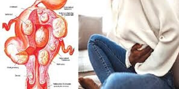 Uterine Fibroids: Symptoms, Causes, and Treatment Options.