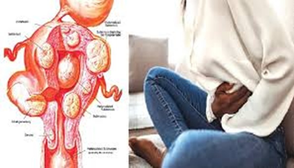 Uterine Fibroids: Symptoms, Causes, and Treatment Options.