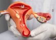 Understanding Thin Endometrium