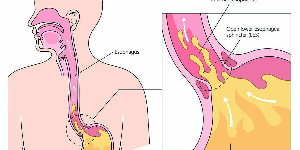 Understanding Acid Reflux.