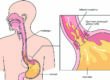 Understanding Acid Reflux.