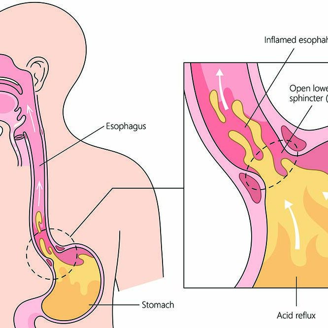 Understanding Acid Reflux.