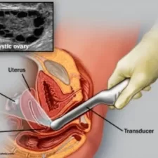 Understanding Your Follicle Scan and Hormone Results Understanding Your Follicle Scan and Hormone Results