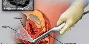 Understanding Your Follicle Scan and Hormone Results