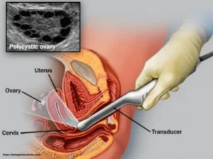 Understanding Your Follicle Scan and Hormone Results Understanding Your Follicle Scan and Hormone Results