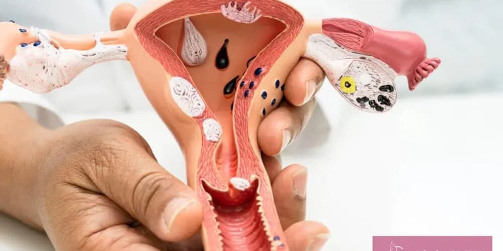 Fibroids and Fertility Fibroids & Fertility