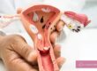 Fibroids & Fertility