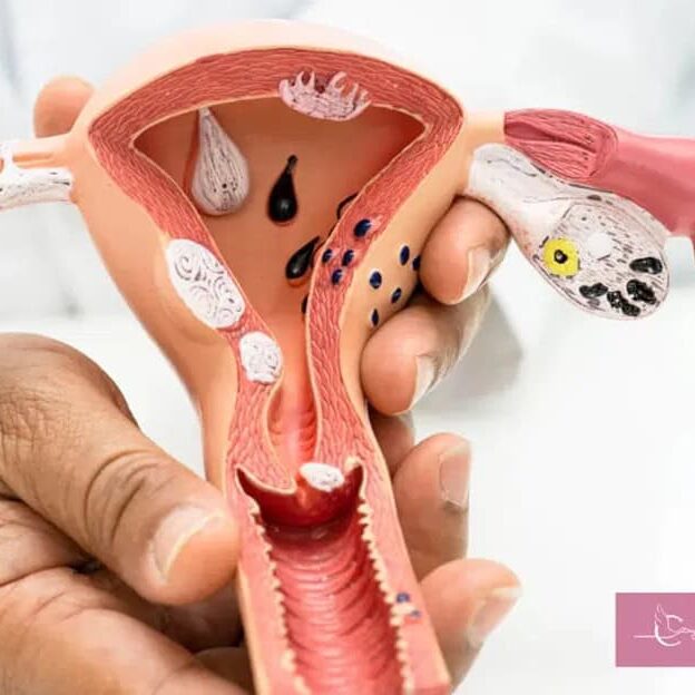 Fibroids & Fertility