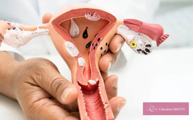 Fibroids & Fertility