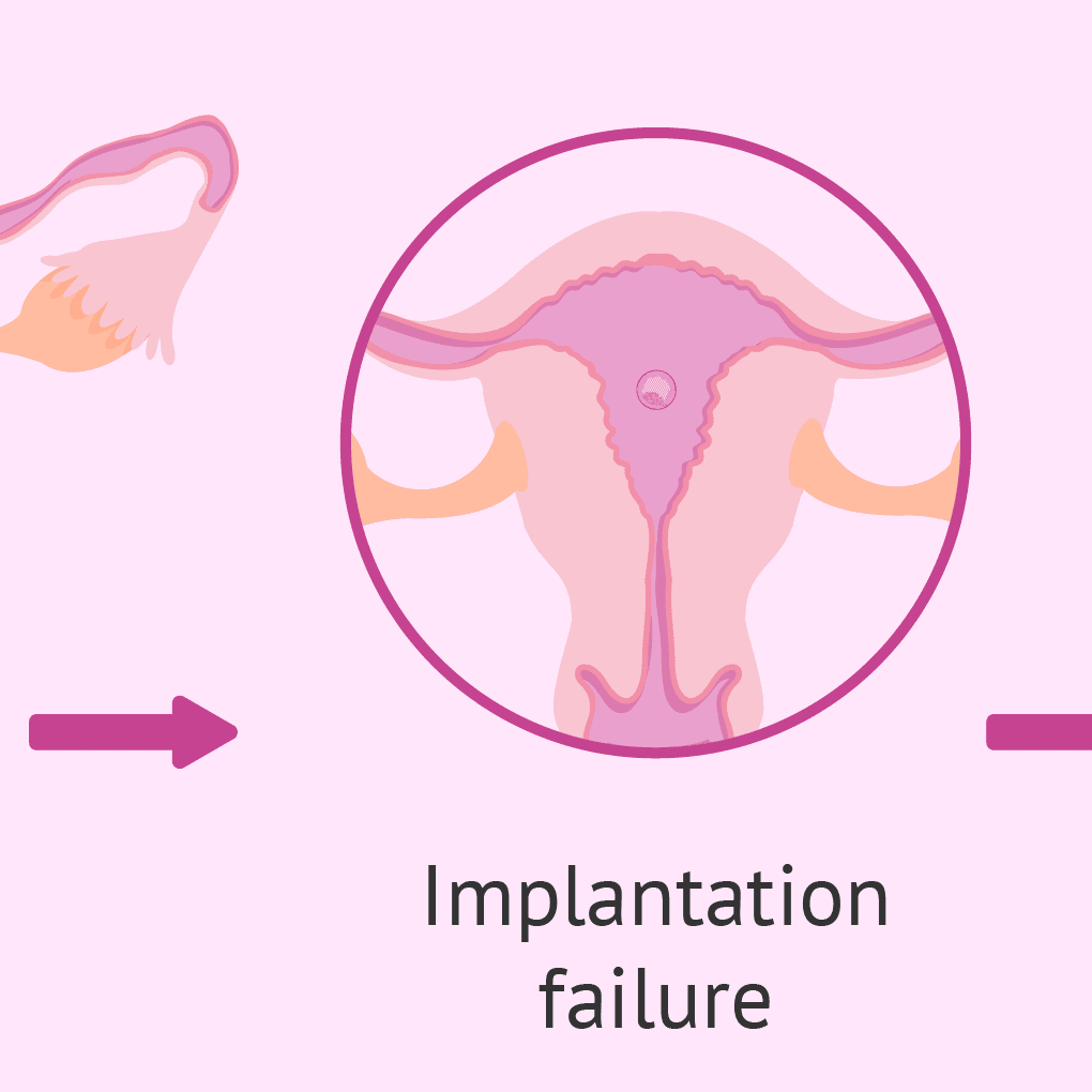 Understanding Repeated Implantation Failure