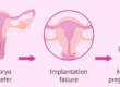Understanding Repeated Implantation Failure
