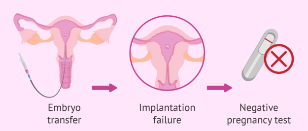 Understanding Repeated Implantation Failure