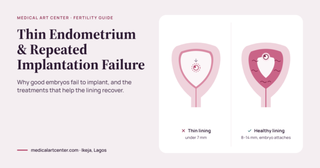 Thin Endometrium and Repeated Implantation Failure